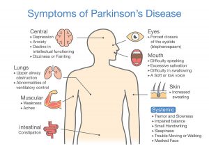 Connection Between Parkinson’s Disease And The Removal Of The Appendix