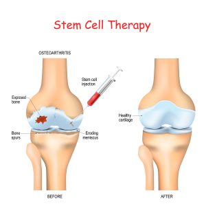 Steroid Injections Are Doing Harm, But Stem Cells Help