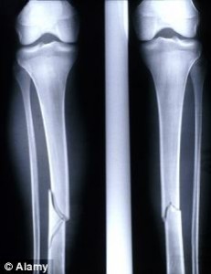 Bone Growth Can Be Stimulated Even In Desperate Cases