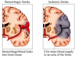 Obesity (Excessive Weight) A Predictor Of High Risk For Stroke