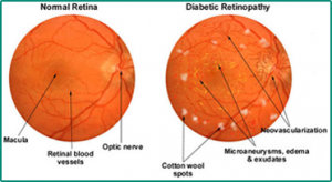 The Liverpool Eye Study...How Often The Eye Sight Of Patients With Diabetes Should Be Examined