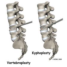 Vertebroplasty And Kyphoplasty...Are These Procedures Safe...
