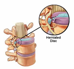 A Slipped Disc...Do Surgery