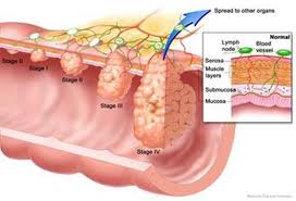 Peritoneal cancer of liver. Hpv liver cancer - granturieuropene.ro Does hpv cause liver cancer