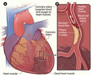 Blood Clot Dissolving Therapy Saves Lives