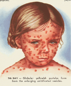 Effect Of Smallpox Vaccination Lasts Much Longer