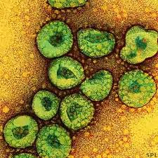 SARS Due To SARS-Associated Coronavirus (SARS-CoV)