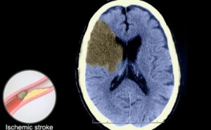 Better Recovery From Strokes Through Early CAT Scans