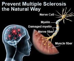 Less Multiple Sclerosis (MS) With Vitamin D Supplement