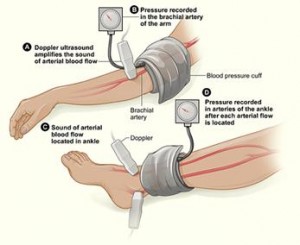 Ankle Blood Pressure Reveals Diabetic Problems