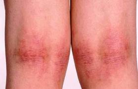 Eczema - More Than Skin Deep