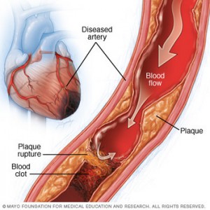 Gene Therapy Can Repair Blood Vessels