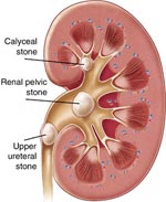 Calcium Prevents Kidney Stones