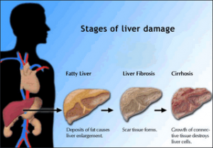 Liver Cirrhosis Threatens Overweight Children