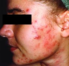 Diet Can Influence Acne