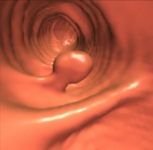 Virtual Colonoscopy May Help Find Other Disease