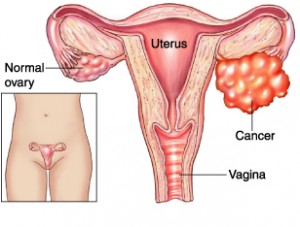 More Education Needed About Ovarian Cancer