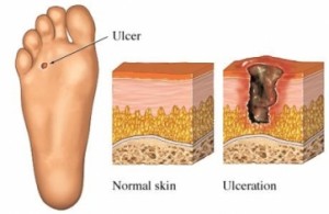Prevent Foot Problems In Diabetics