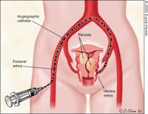 Uterine Artery Embolization Against Fibroids