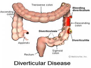 Diverticulitis Associated With Obesity