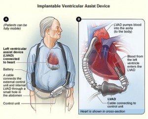 Mechanical Heart As Transplant Alternative