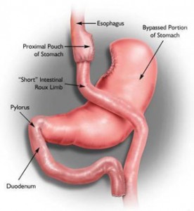 Weight Loss Surgery Reduces Mortality