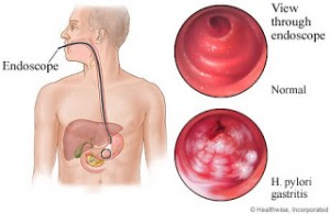 H. Pylori Can Be The Culprit For Indigestion