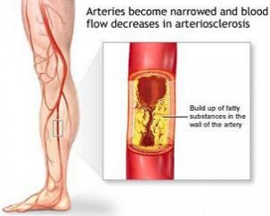 Disease Of Peripheral Blood Vessels Occurs With Metabolic Changes