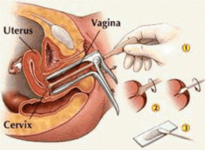 Low Cost Cervical Cancer Screening