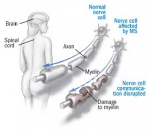 MS Is A Multifaceted Disease