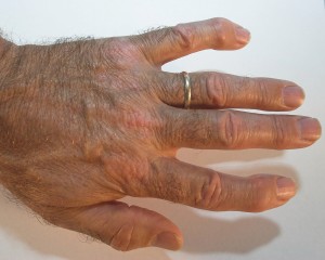 Stop Suffering From Arthritis