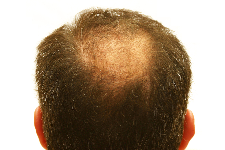 there is help for hair loss