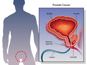 Prostate Cancer Treatment Is Often Inadequate