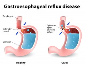 Death From Heartburn Drugs