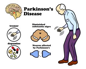 Parkinson’s Disease May Be Stopped