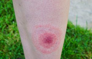 Lyme Disease The Great Imitator