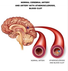 Prevent Plugged Arteries