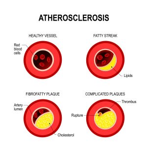 What lowers LDL cholesterol?