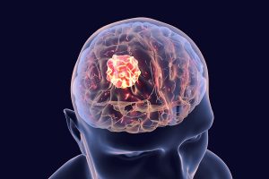 Modified Poliovirus Effective Against Brain Cancer