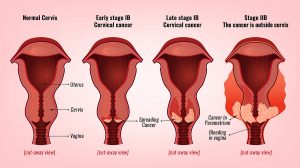 HPV Testing For Cervical Cancer