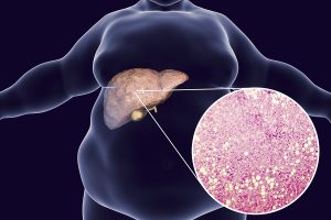 Non-Alcoholic Fatty Liver Disease