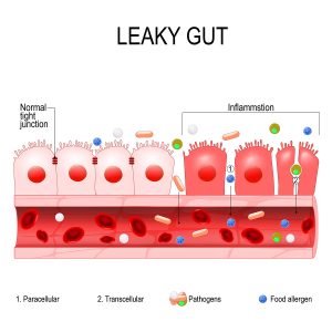 Celiac Disease in Various Disguises