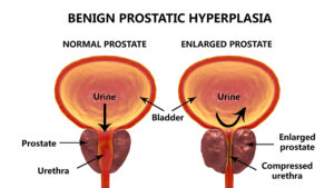 Green Light Laser Treatment for an Enlarged Prostate