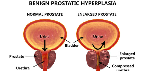 Green Light Laser Treatment for an Enlarged Prostate