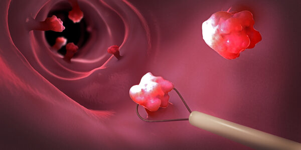 Colorectal Cancer in a younger Population