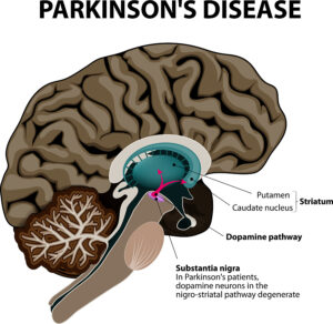 How the Immune System affects Parkinson’s Disease