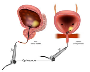 New Treatment against Advanced Bladder Cancer