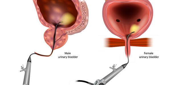 New Treatment against Advanced Bladder Cancer