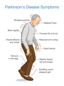 Help to Walk for Parkinson’s Disease Patients