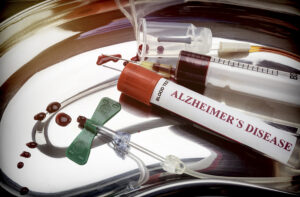 New Blood Test for Alzheimer’s Disease